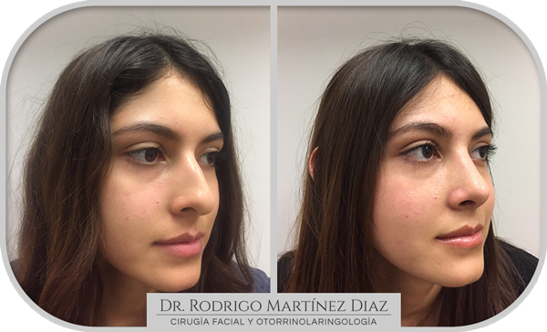 img_rinoplastia_G3