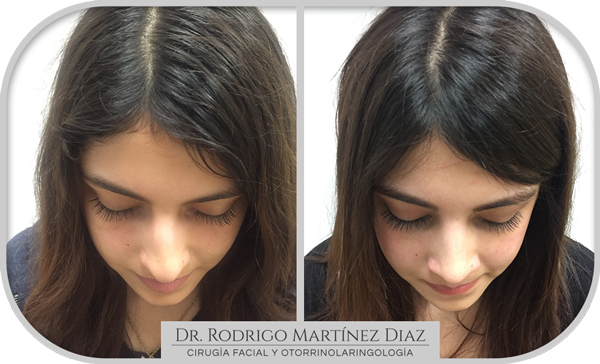 img_rinoplastia_G4