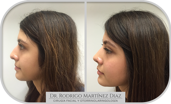 img_rinoplastia_G5