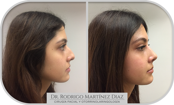img_rinoplastia_G5