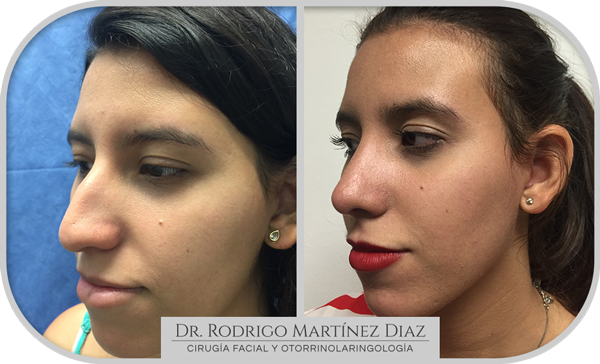 img_rinoplastia_Q1