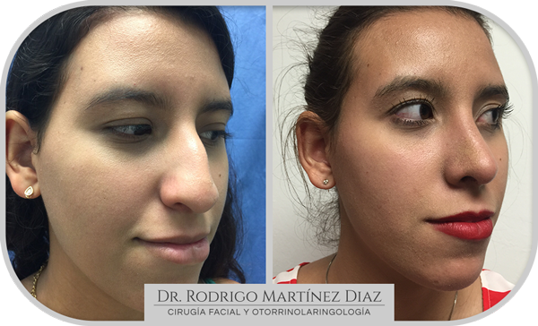 img_rinoplastia_Q2