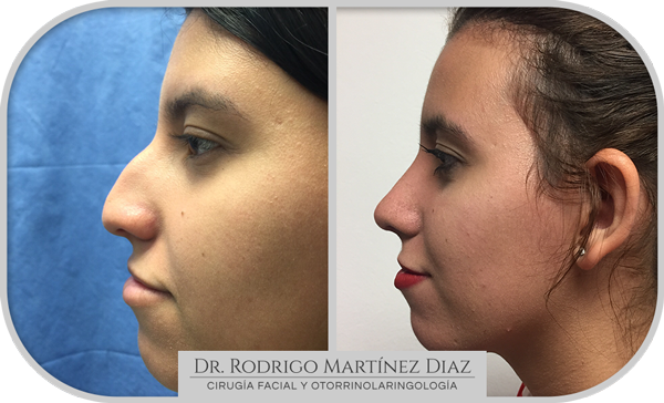 img_rinoplastia_Q3
