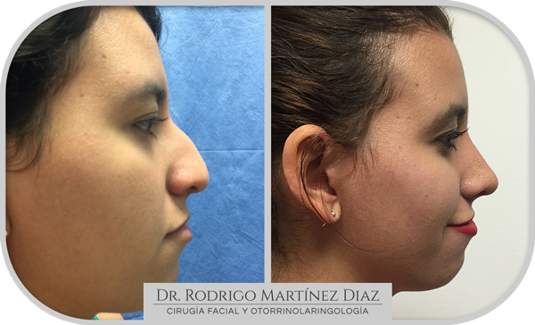 img_rinoplastia_Q4