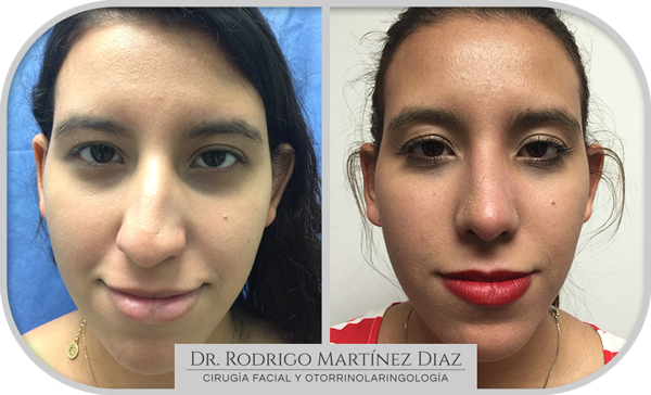 img_rinoplastia_Q4