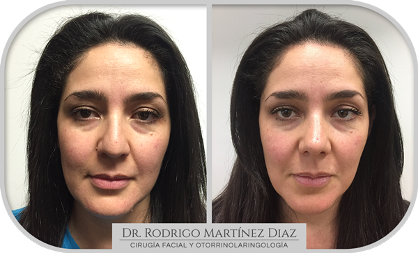 img_rinoplastia_H1