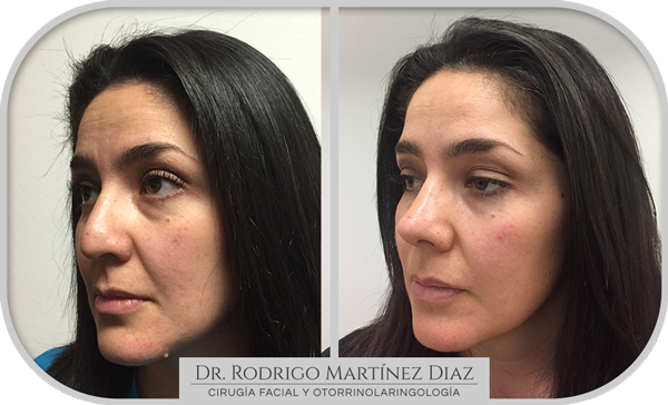 img_rinoplastia_H2