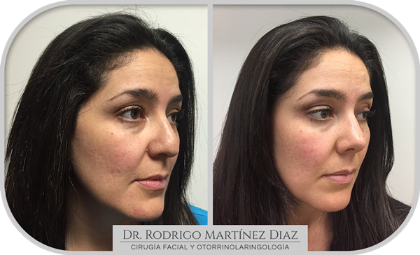img_rinoplastia_H3