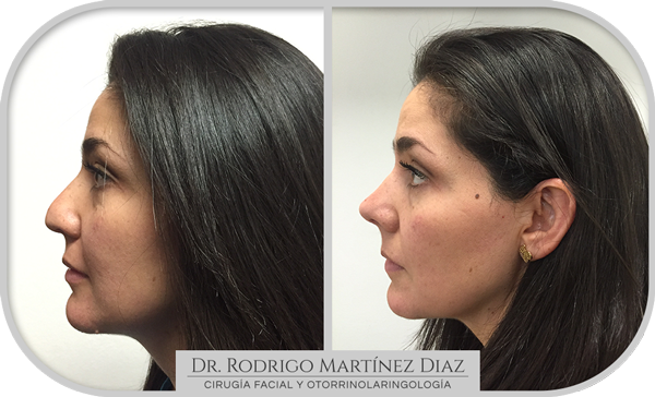 img_rinoplastia_H4