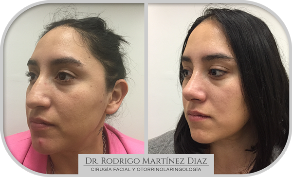 img_rinoplastia_R1