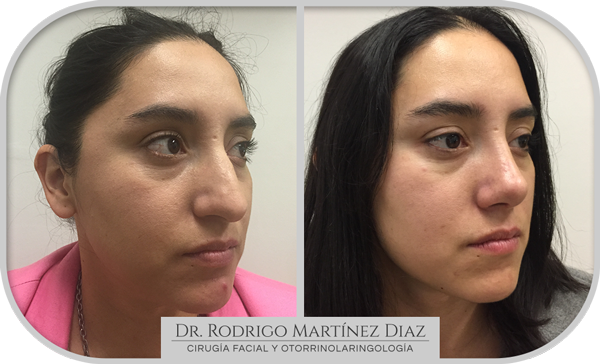 img_rinoplastia_R2