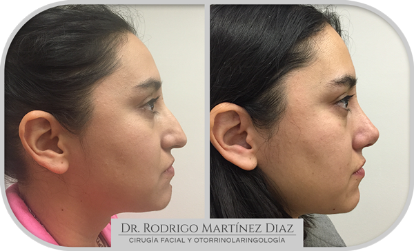 img_rinoplastia_R4