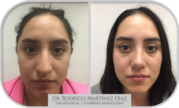 img_rinoplastia_R4