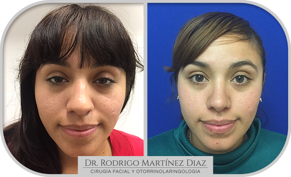img_rinoplastia_I1
