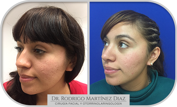 img_rinoplastia_I2