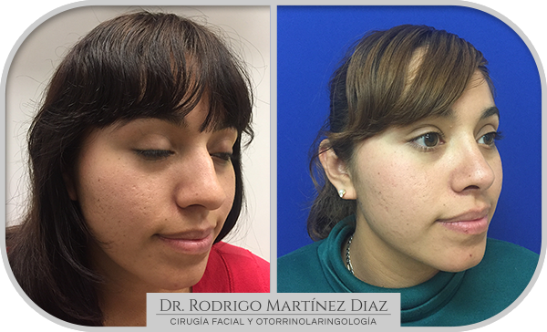 img_rinoplastia_I3