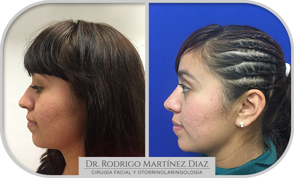 img_rinoplastia_I5