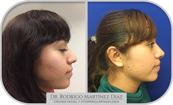 img_rinoplastia_I5