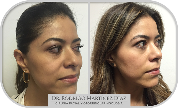 img_rinoplastia_S2