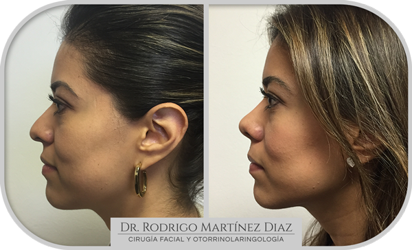 img_rinoplastia_S3