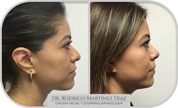 img_rinoplastia_S4