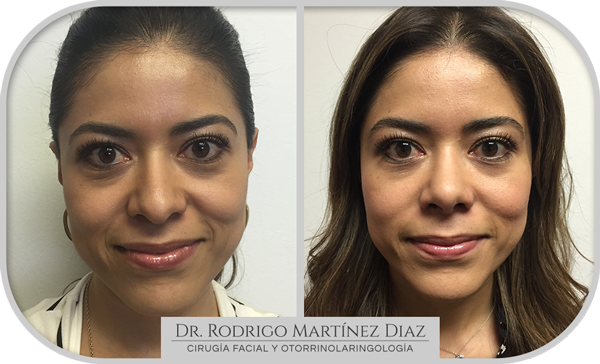 img_rinoplastia_S5