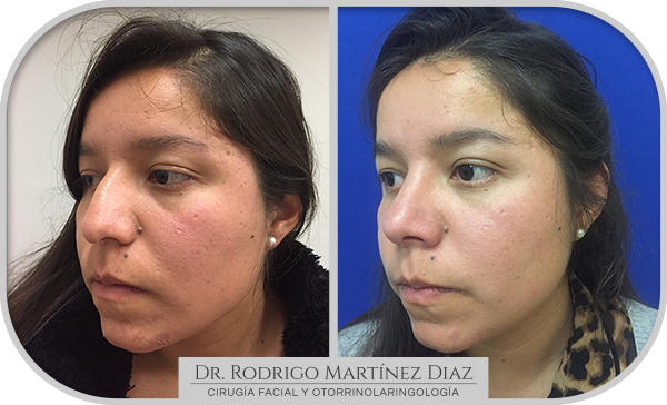 img_rinoplastia_D2