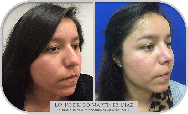 img_rinoplastia_D3