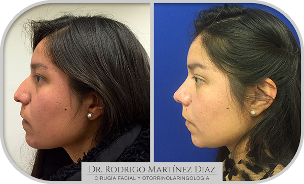 img_rinoplastia_D4