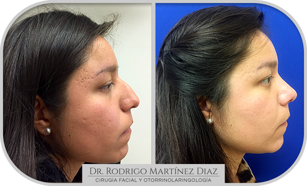 img_rinoplastia_D5