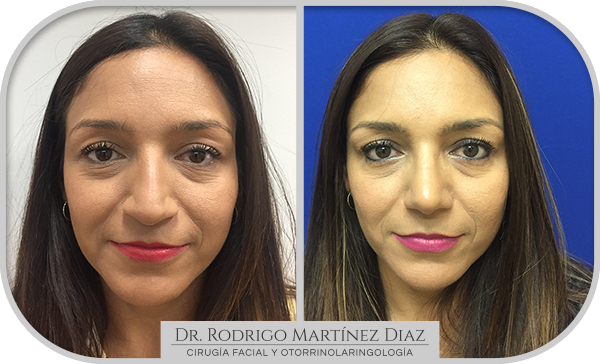 img_rinoplastia_C1