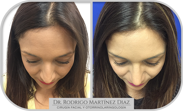 img_rinoplastia_C2