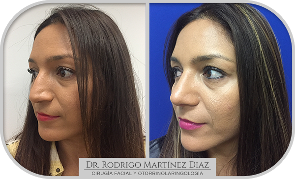 img_rinoplastia_C3