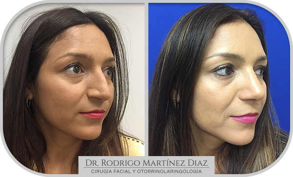 img_rinoplastia_C4