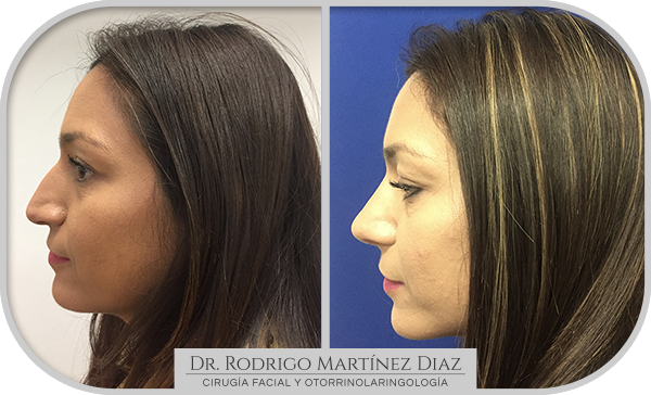 img_rinoplastia_C5