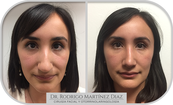 img_rinoplastia_B1