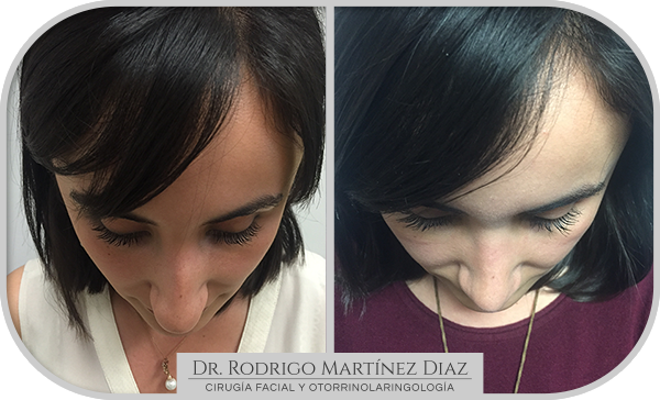 img_rinoplastia_B2