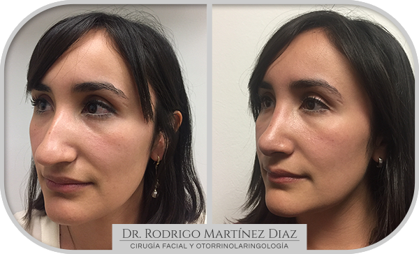 img_rinoplastia_B3