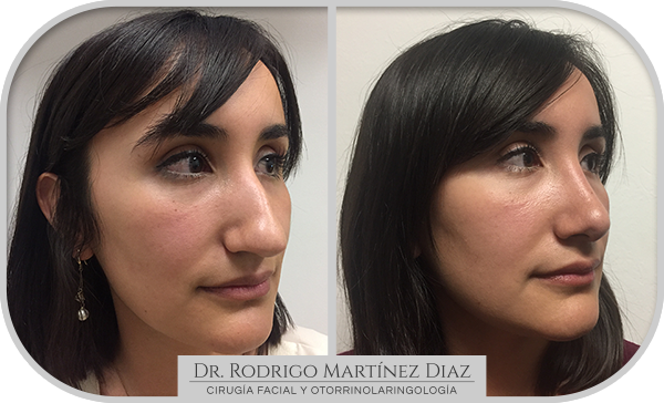 img_rinoplastia_B4