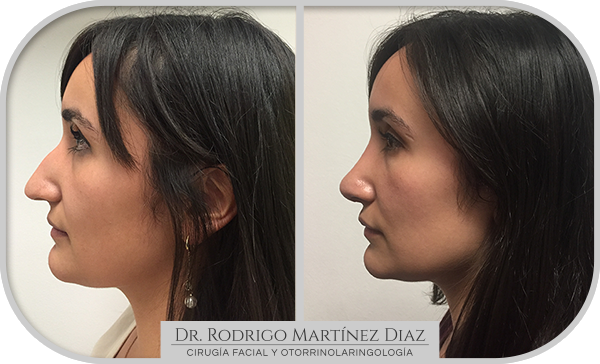 img_rinoplastia_B5