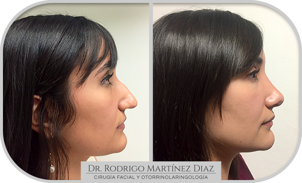 img_rinoplastia_B6