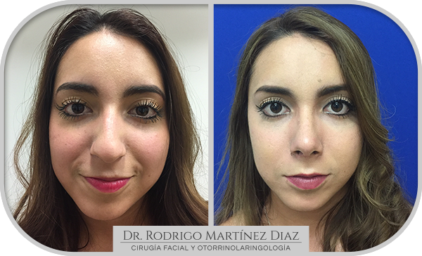 img_rinoplastia_E1