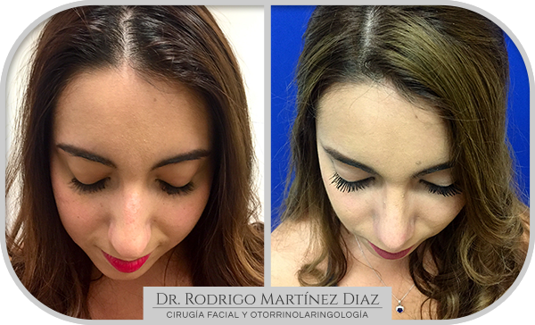 img_rinoplastia_E2
