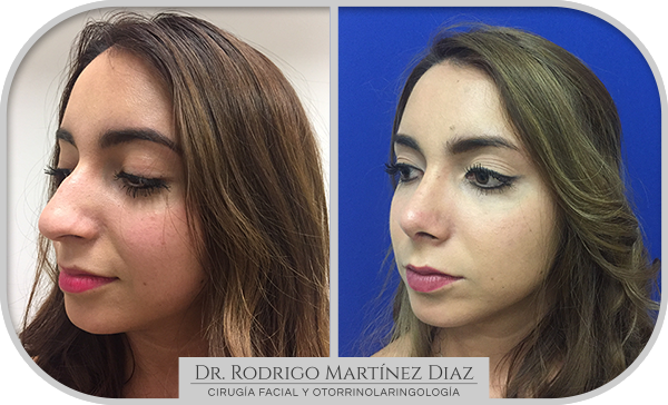 img_rinoplastia_E3