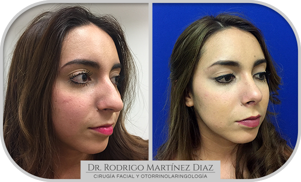 img_rinoplastia_E4