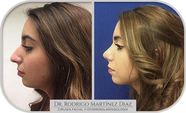 img_rinoplastia_E5
