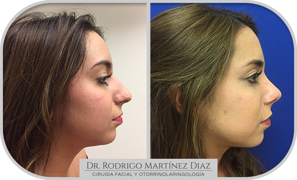 img_rinoplastia_E5