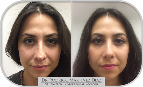 img_rinoplastia_J1