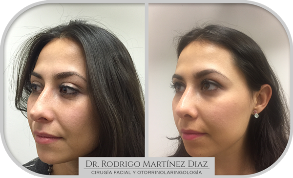 img_rinoplastia_J2