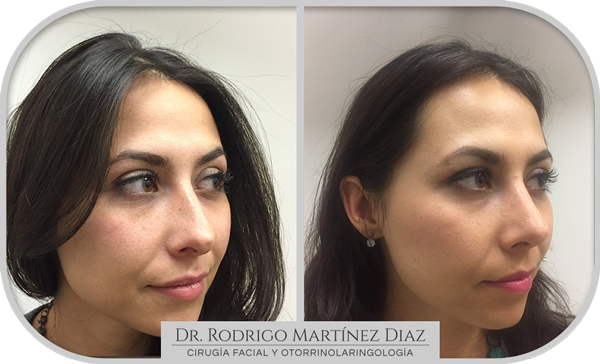 img_rinoplastia_J3